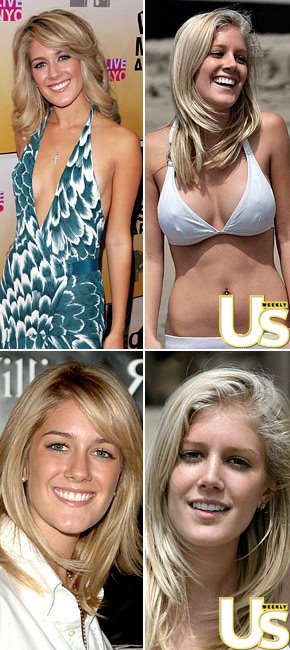 Heidi Montag before and after